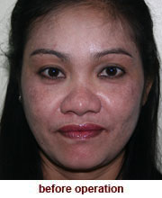 plastic_surgery_augmentation_rhinoplasty